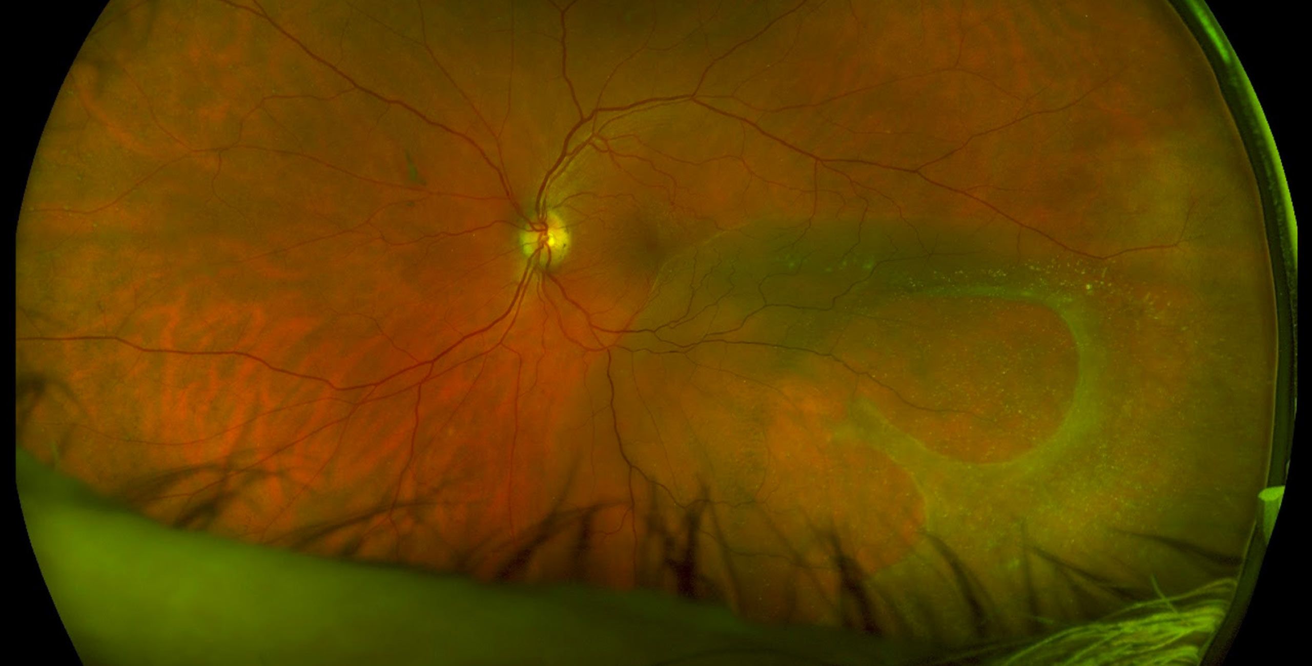 Chirurgie de la rétine à Plaisir | Décollement de la rétine opération | Centre ophtalmologique | COPYV