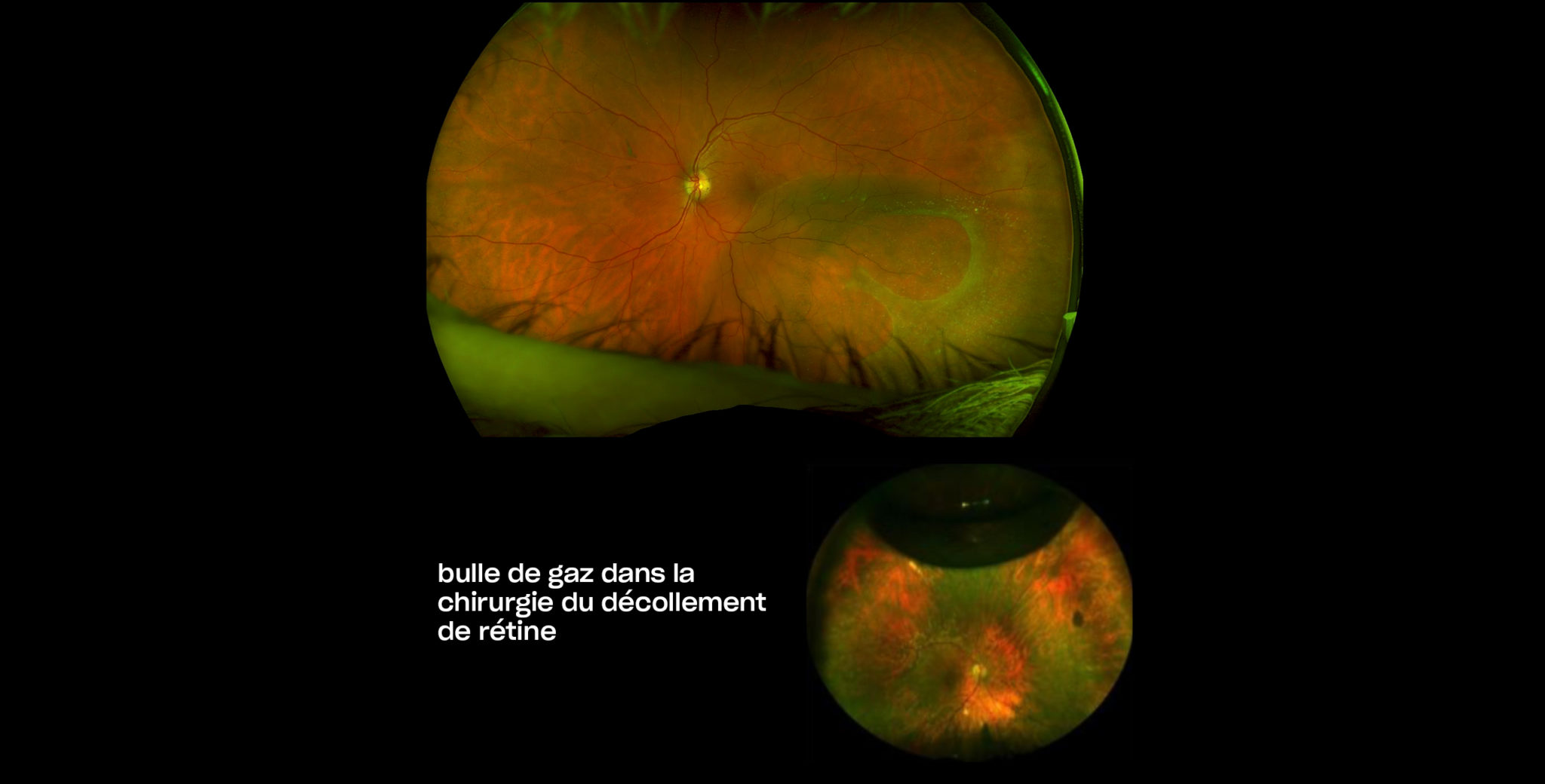 cover-chirurgie-decollement-retine-plaisir-copyv Décollement de rétine à Plaisir | Décollement de la rétine chirurgie | Centre ophtalmologique | COPYV