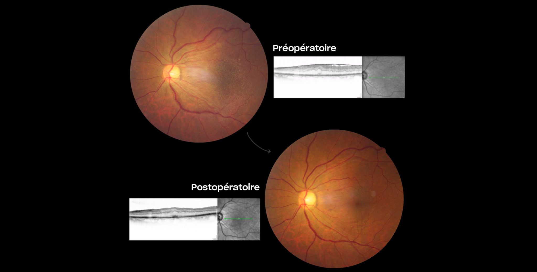 cover-chirurgie-membrane-epiretinienne-plaisir-copyv Chirurgie de la membrane épirétinienne à Plaisir | Coût opération membrane épirétinienne | Ophtalmologie | COPYV