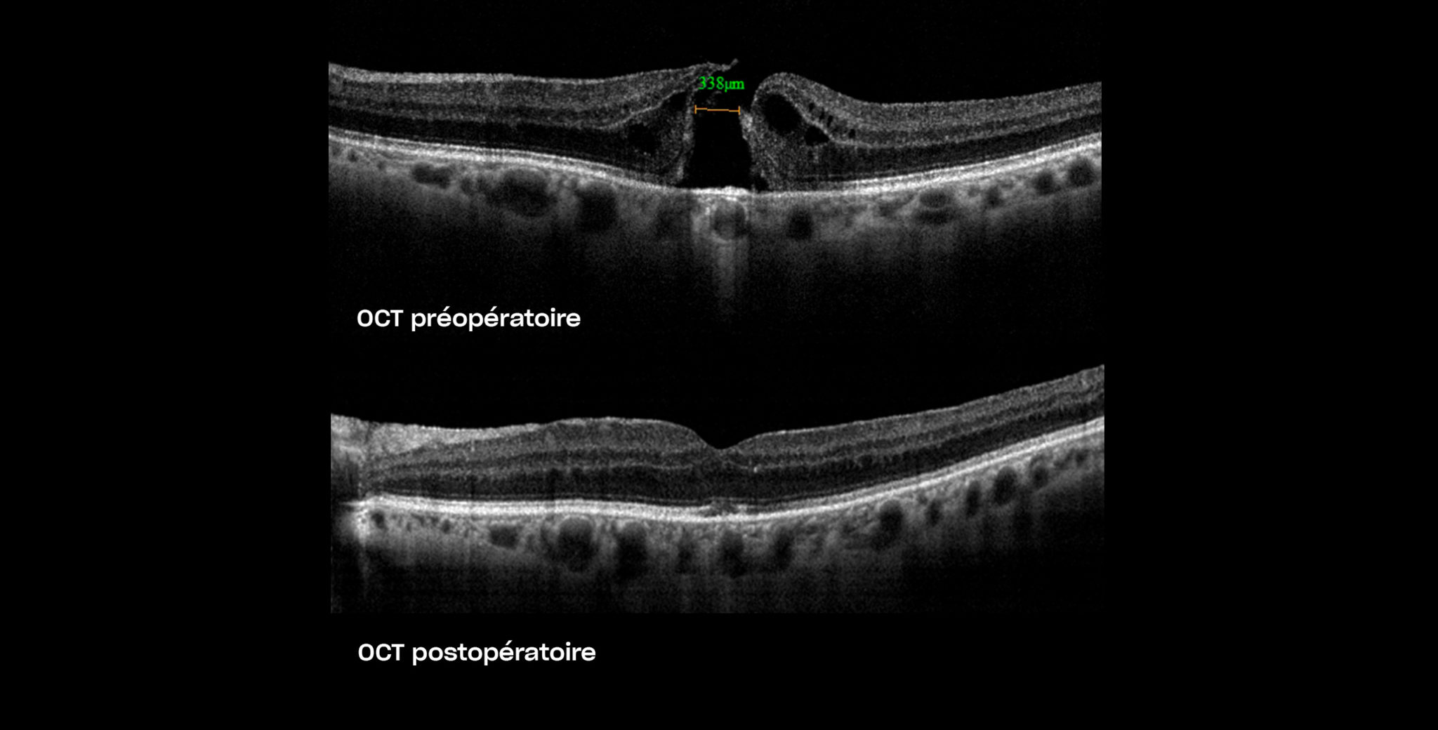 cover-chirurgie-trou-maculaire-plaisir-copyv Chirurgie du trou maculaire à Plaisir | Prix opération trou maculaire | Centre ophtalmologique | COPYV
