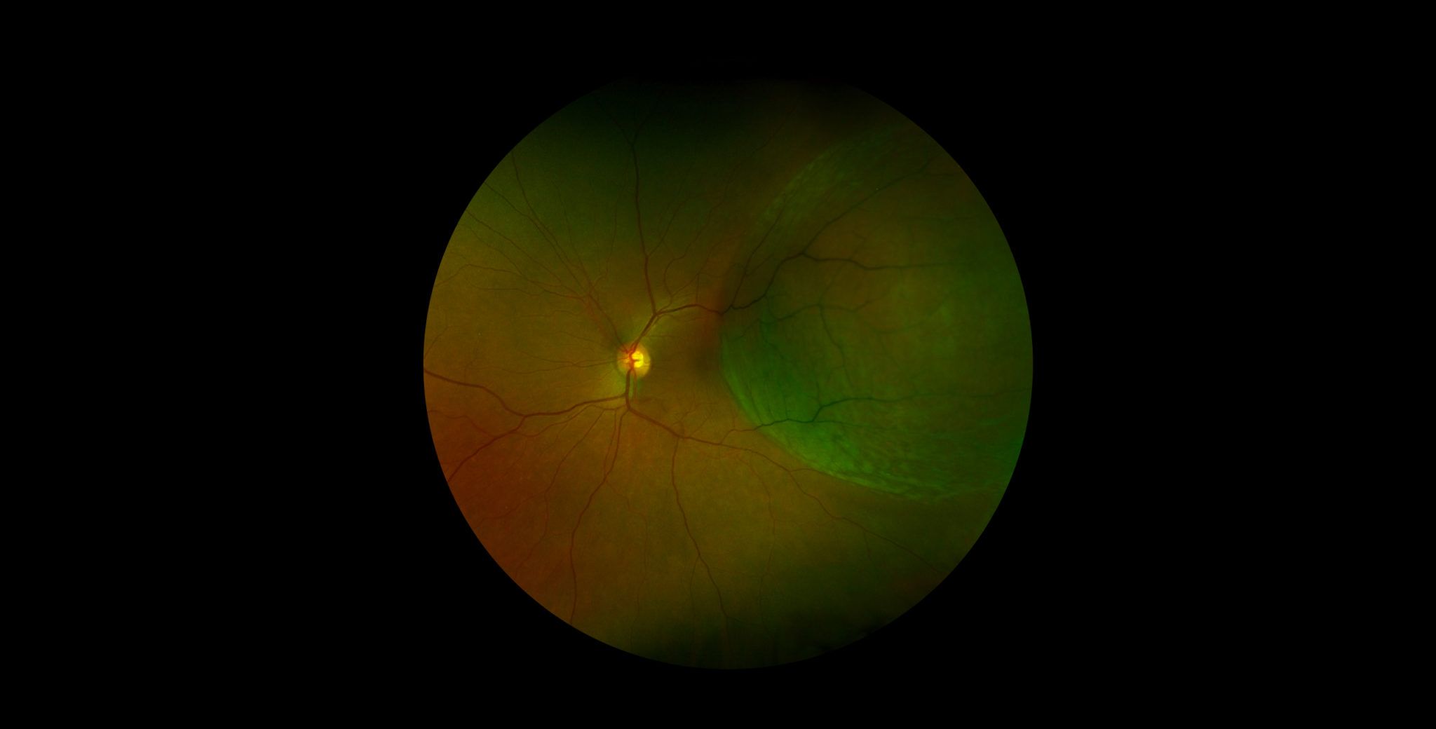 cover-decollement-retine-plaisir-copyv Décollement de rétine : causes et traitements | Chirurgie décollement de rétine | COPYV | Plaisir