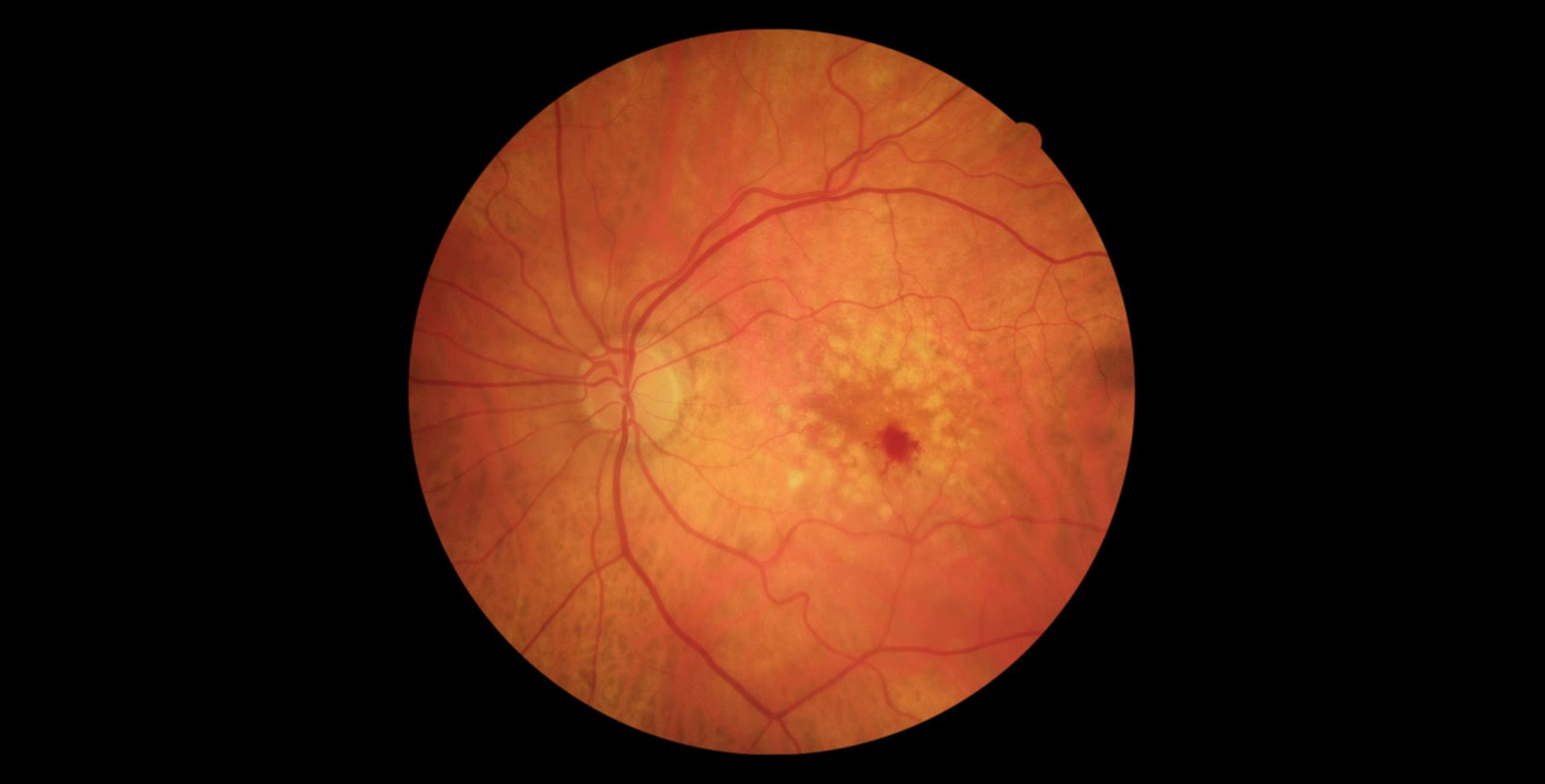 cover-degenerescence-maculaire-liee-a-l-age-dmla-plaisir-copyv Dégénérescence maculaire liée à l'âge (DMLA) | DMLA traitement, dégénérescence maculaire symptômes | COPYV | Plaisir