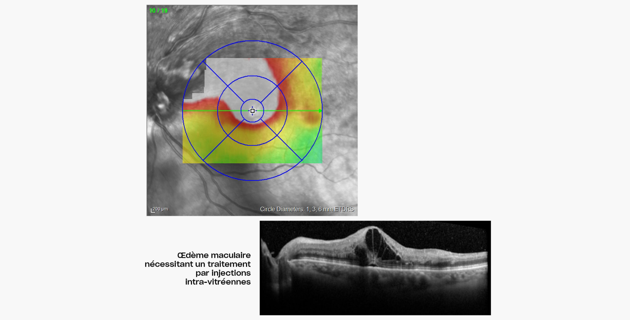 Injections intra-vitréennes (IVT) à Plaisir | Dégénérescence maculaire liée à l'âge, rétinopathie | Ophtalmologie | COPYV